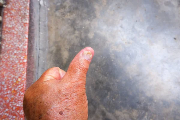Грибок Пальце Большого Пальца Старика — стоковое фото