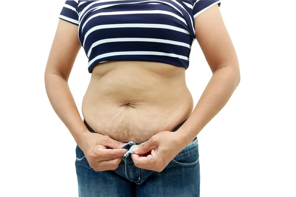 Superfície abdominal da mulher gorda — Fotografia de Stock