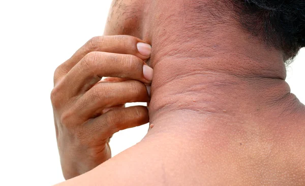 Der allergische Hautausschlag — Stockfoto