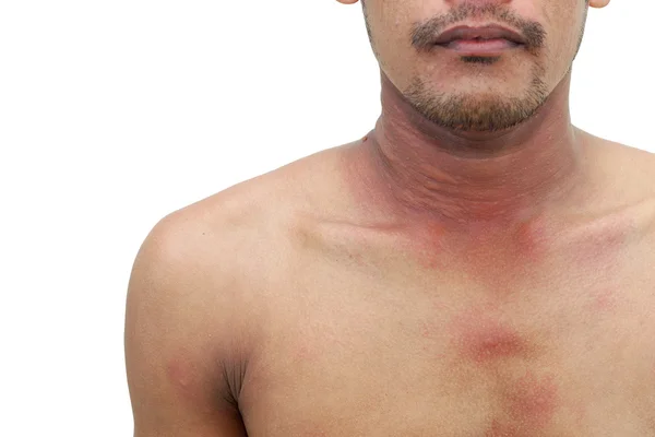The allergy rash — Stock Photo, Image