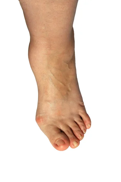 Deforming arthrosis on leg — Stock Photo, Image