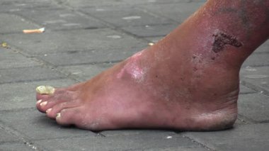 Brno, Çek Cumhuriyeti - 1 Eylül 2015: sera anında bir hasta bacak evsiz, kasaba Brno, Çek Cumhuriyeti, Avrupa, AB