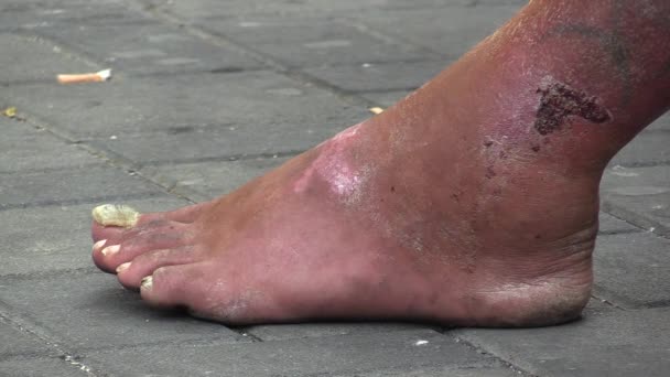 ブルノ チェコ共和国 2015 悪い障害者のホームレスの男性は病気の足 チェコ共和国 ヨーロッパ — ストック動画
