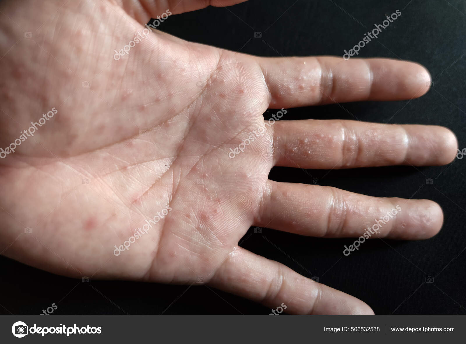 Eczema Baby Stock Photos Royalty Free Eczema Baby Images Depositphotos Eczema Baby Stock Photos Royalty Free Eczema Baby Images Depositphotos