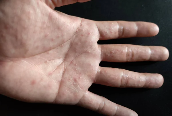 Eczema Disidrotico Una Condizione Allergica Della Pelle Sintomo Eruzione Cutanea — Foto Stock