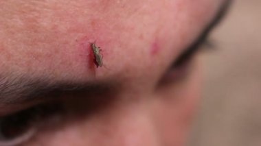 Sivrisinek kadın alnına ısır.