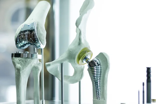 Protezy stawu kolanowego i biodrowego — Zdjęcie stockowe