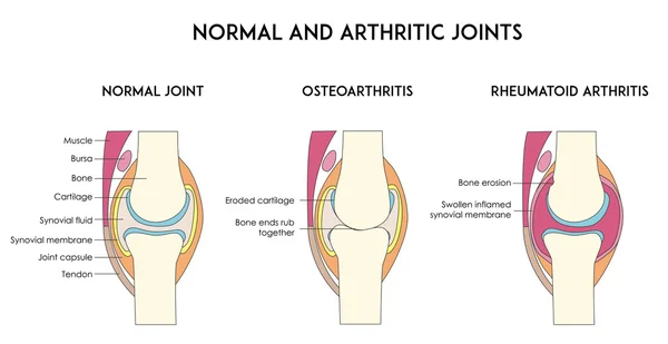 Articulaciones humanas normales y artríticas . — Archivo Imágenes Vectoriales