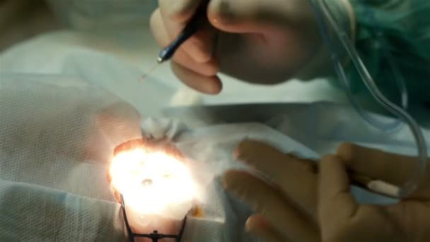 Oční operace. Chirurgové ruce v rukavicích provedení laserové oko vidění korekce korekce — Stock video