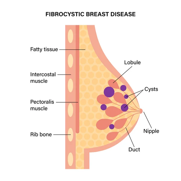 Begrip borstziekte — Stockvector