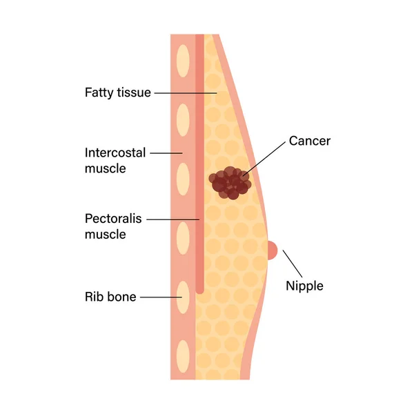 유방암 개념 — 스톡 벡터