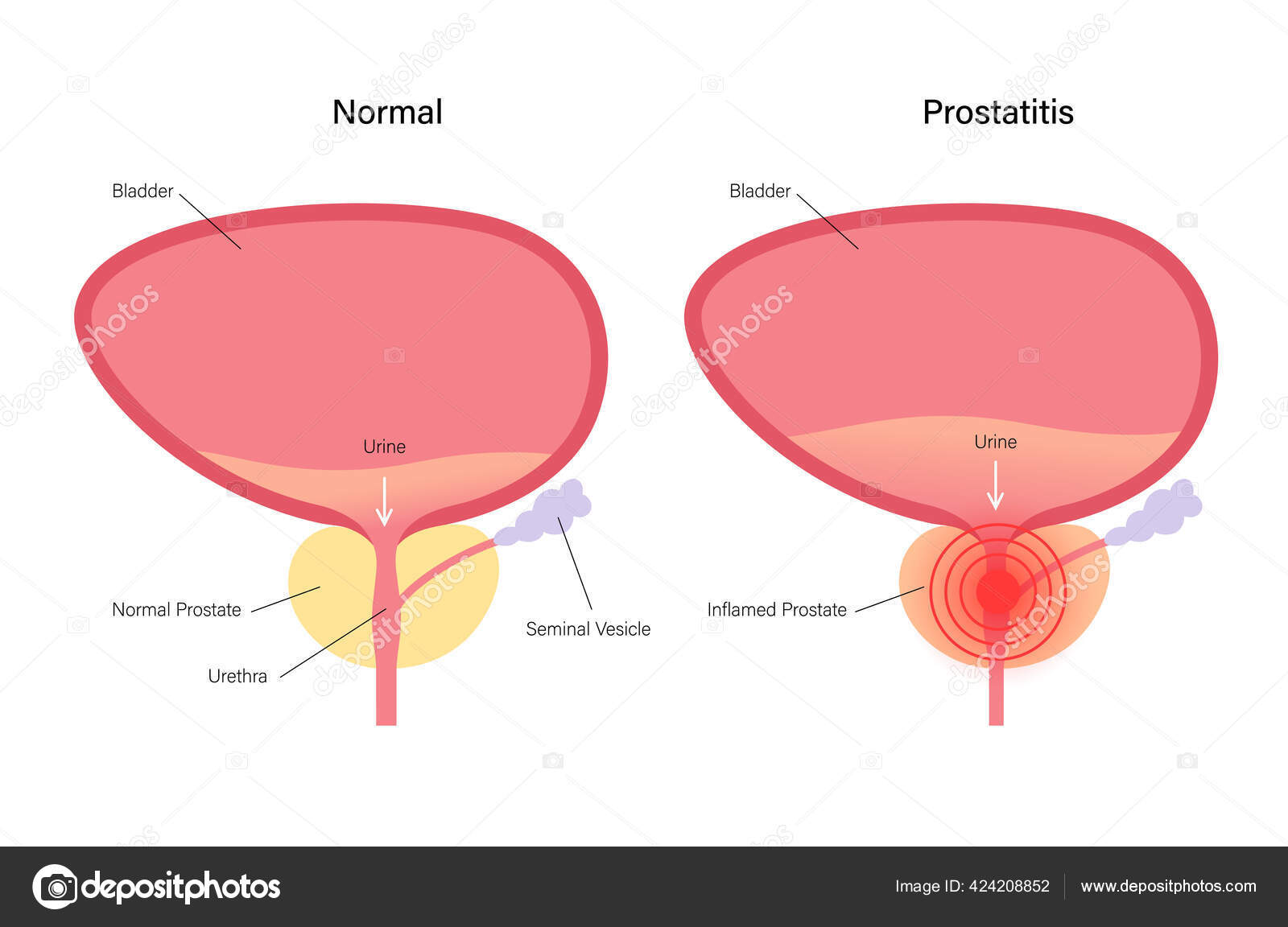 prostatitis harbingers alhasi görcs derékfájdalom terhesség