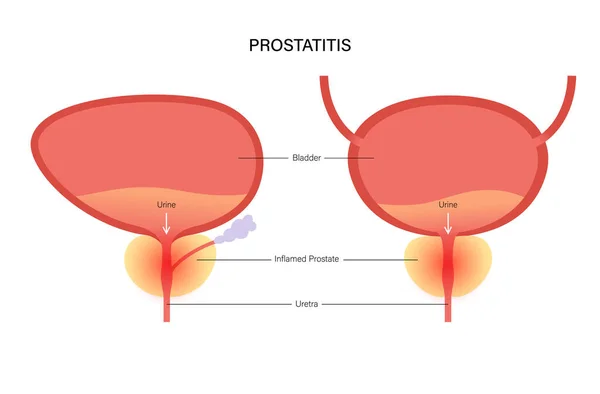 bogyók prosztatitis)