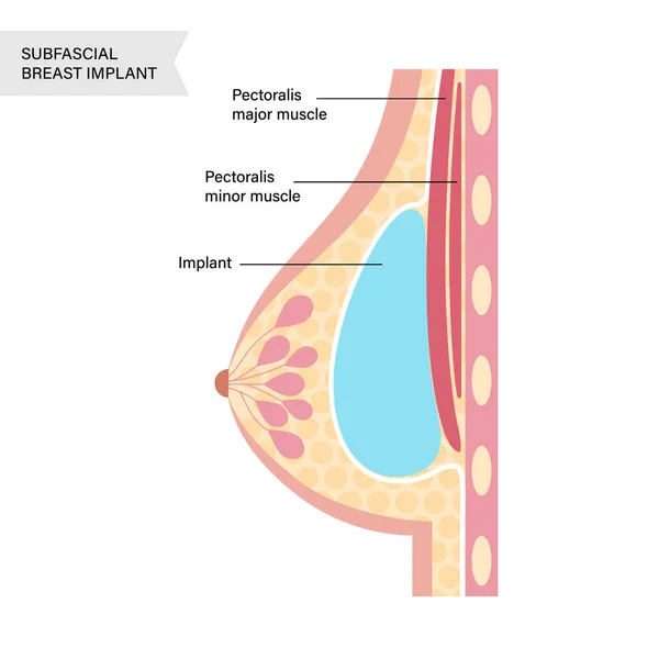 乳房インプラントのコンセプト — ストックベクタ
