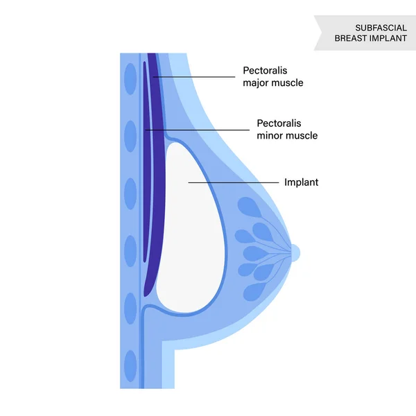 Concept d'implant mammaire — Image vectorielle