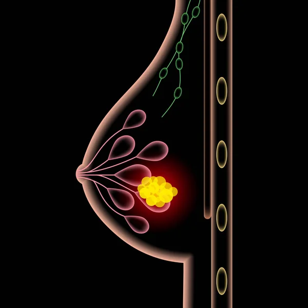 Концепція захворювання молочної залози — стоковий вектор