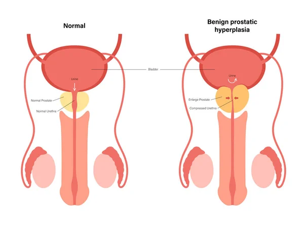 BPH 정보 개념 — 스톡 벡터