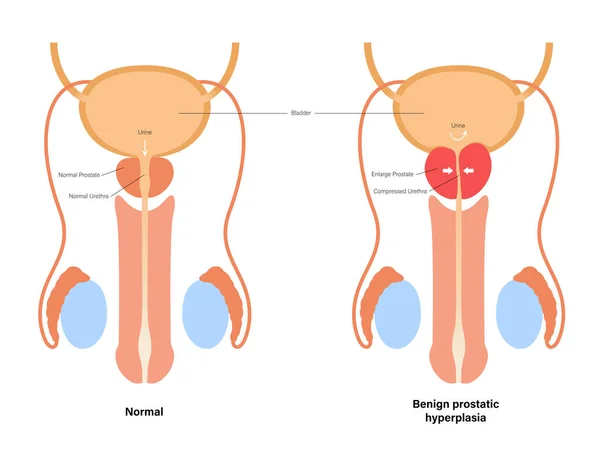 BPH 정보 개념 — 스톡 벡터