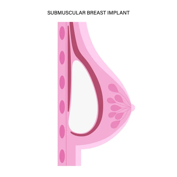 Concepto de implante mamario — Archivo Imágenes Vectoriales