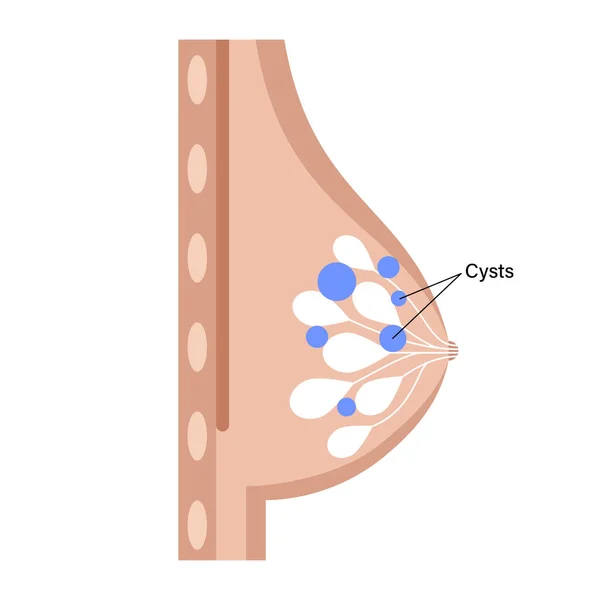 乳腺癌的概念 — 图库矢量图片