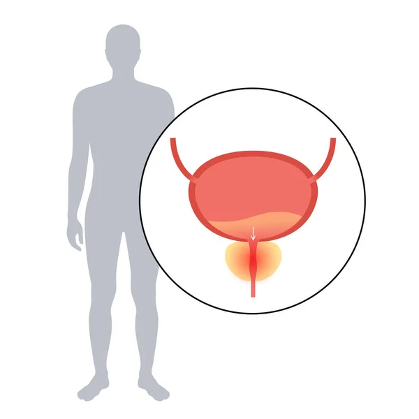 Entzündungsproblem der Prostatitis — Stockvektor