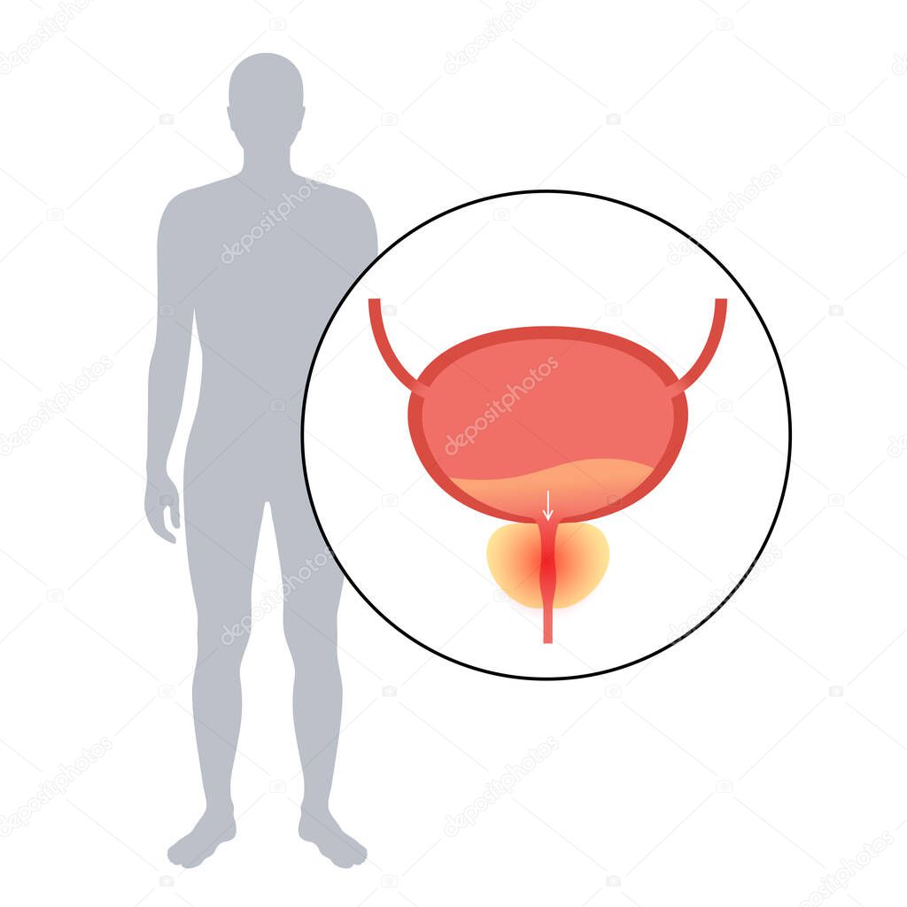 Prostatitis swelling and inflammation of prostate gland. Painful and difficult urination diagnosis. Disease and pain in the human male body. Bladder anatomy concept. Medical flat vector illustration.