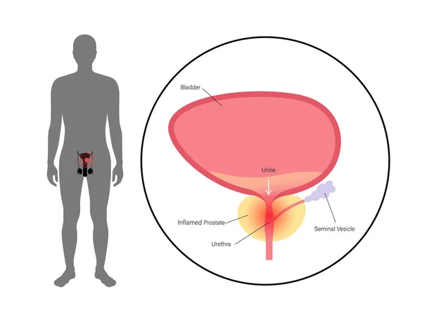 Problema de inflamação da prostatite —  Vetores de Stock