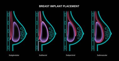 Göğüs implantı kavramı
