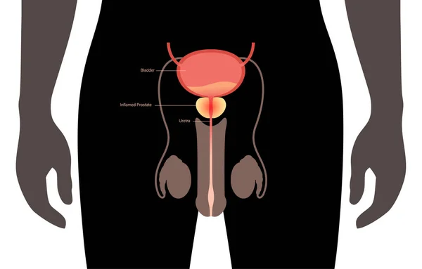 Problema de inflamação da prostatite — Vetor de Stock