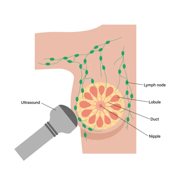 Concepto de enfermedad mamaria — Vector de stock