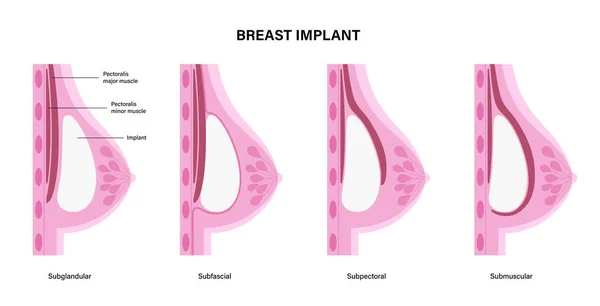 Concepto de implante mamario — Archivo Imágenes Vectoriales