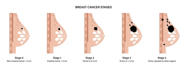 乳腺癌的概念 — 图库矢量图片