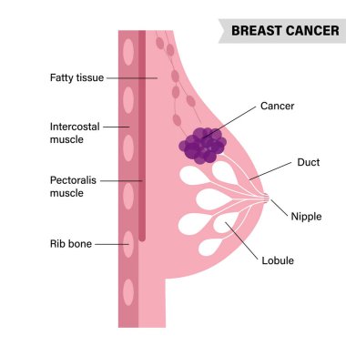 Göğüs hastalığı konsepti