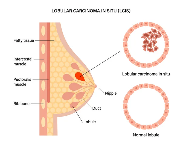 乳腺癌的概念 — 图库矢量图片