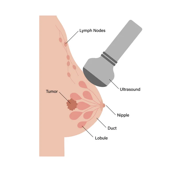 Έννοια νόσου του μαστού — Διανυσματικό Αρχείο