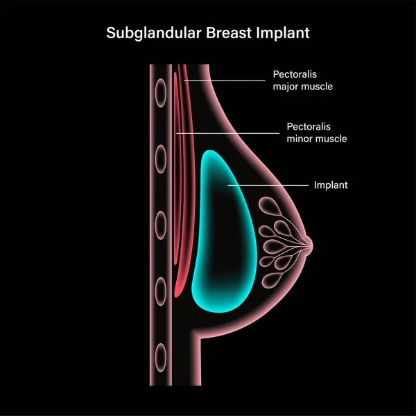 Conceito de implante mamário —  Vetores de Stock