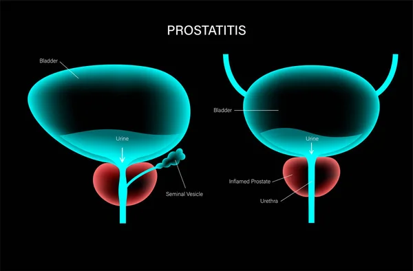 prostatitis és kezelésük otthon gyertyák prosztataárral