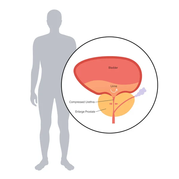 BPH info koncept — Stockový vektor