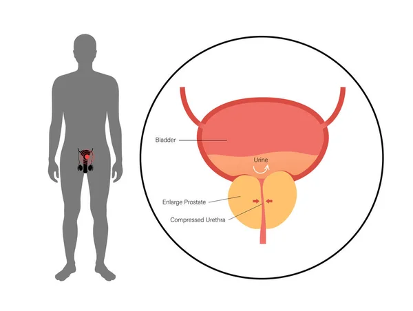 BPH info concept — стоковий вектор