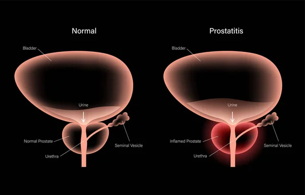 Problema de inflamação da prostatite — Vetor de Stock