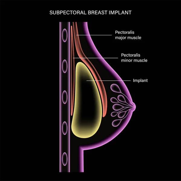 Göğüs implantı kavramı — Stok Vektör