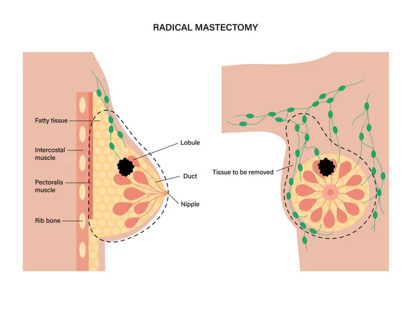 Concepto de enfermedad mamaria — Vector de stock