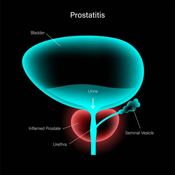 Problema de inflamación de la prostatitis — Archivo Imágenes Vectoriales