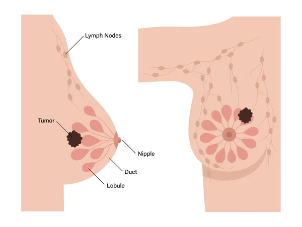 乳腺癌的概念 — 图库矢量图片