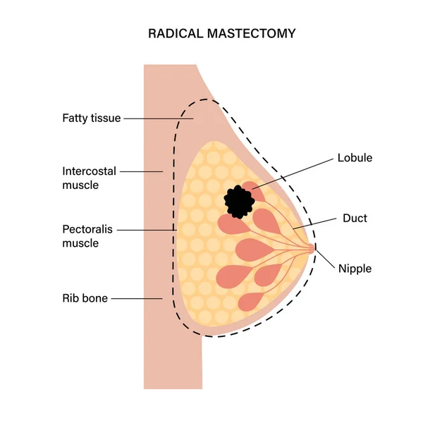 Concept de maladie mammaire — Image vectorielle