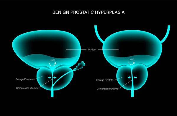 BPH info concept — Image vectorielle