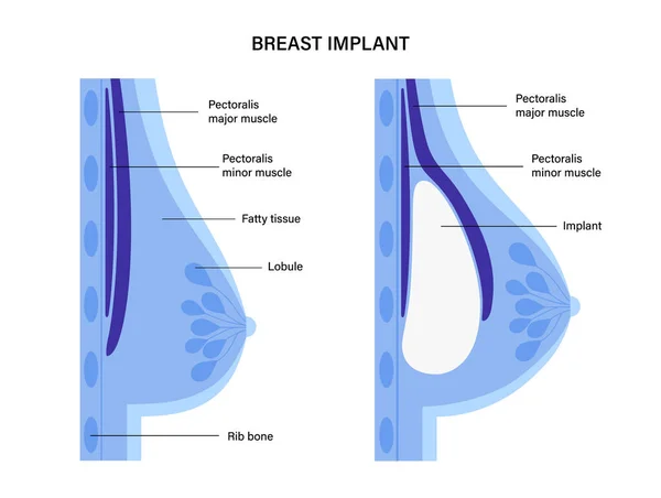 Conceito de implante mamário — Vetor de Stock