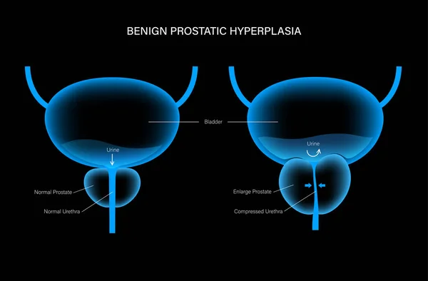 Concetto BPH info — Vettoriale Stock