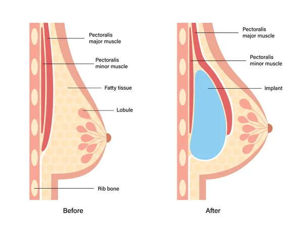 Concepto de implante mamario — Vector de stock