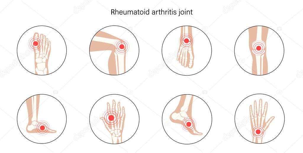Rheumatoid arthritis, inflammation, bone disease concept. Set with spine, knee, wrist and other joint icons for clinic. Pain in the human body, anatomical medical poster. Xray flat vector illustration